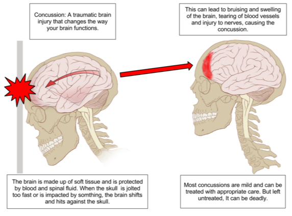 Image: Drugless Doctors: Concussions How They Can Be Helped Naturally!!!